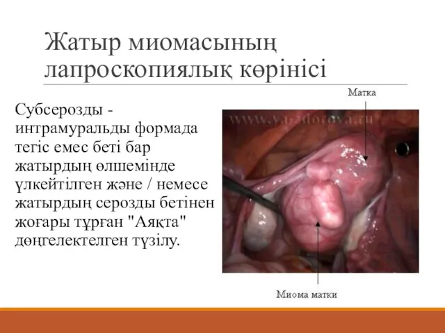 Жатыр миомасының лапроскопиялық көрінісі Субсерозды - интрамуральды формада тегіс емес