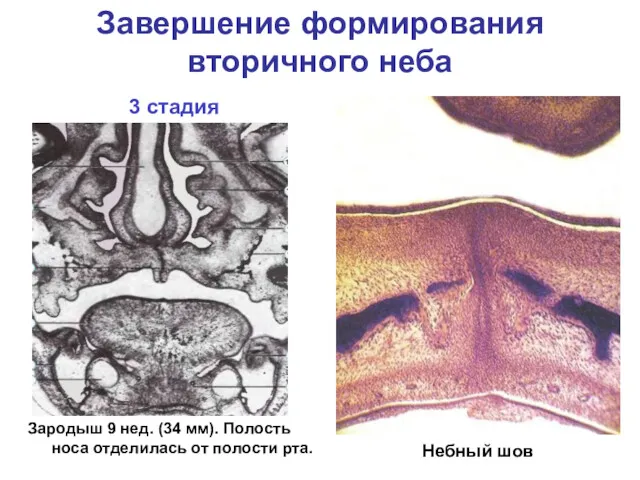 Завершение формирования вторичного неба Небный шов 3 стадия Зародыш 9