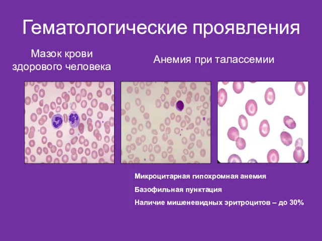 Гематологические проявления Мазок крови здорового человека Анемия при талассемии Микроцитарная гипохромная анемия Базофильная