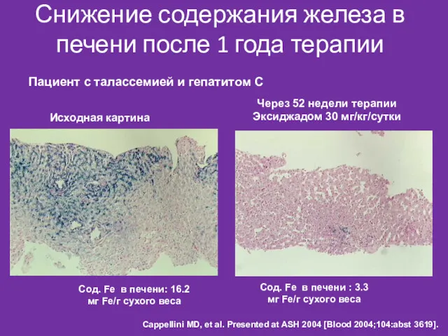 Исходная картина Через 52 недели терапии Эксиджадом 30 мг/кг/сутки Сод. Fe в печени: