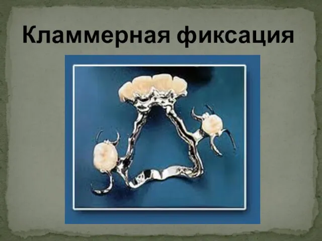 Кламмерная фиксация