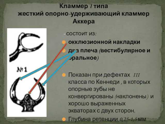 - состоит из: окклюзионной накладки два плеча (вестибулярное и оральное)