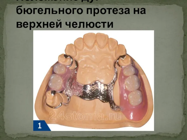 Положение дуг бюгельного протеза на верхней челюсти