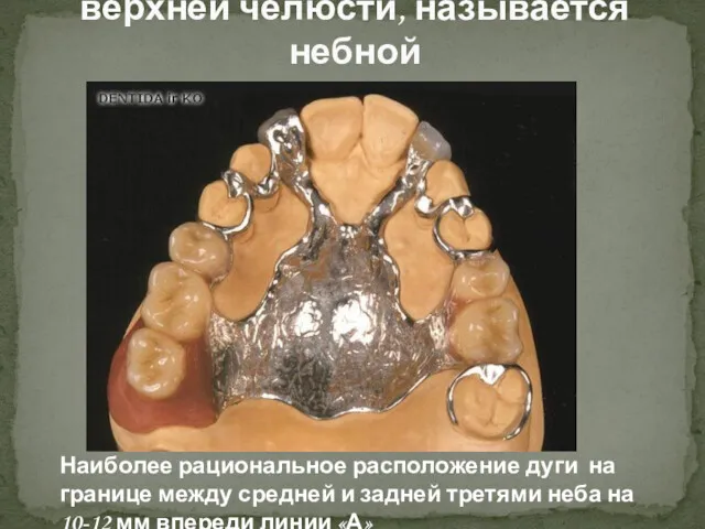 Дуга, располагающаяся на верхней челюсти, называется небной Наиболее рациональное расположение