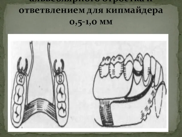 Величина зазора между слизистой оболочкой альвеолярного отростка и ответвлением для кипмайдера 0,5-1,0 мм