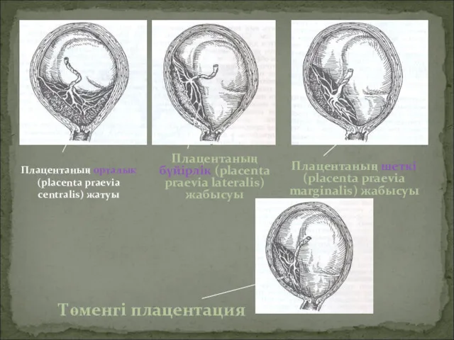 Плацентаның орталық (placenta praevia centralis) жатуы Плацентаның бүйірлік (placenta praevia lateralis) жабысуы Плацентаның