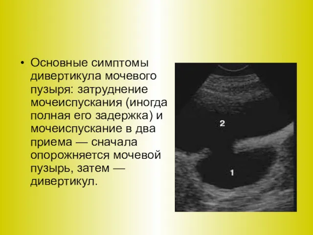 Основные симптомы дивертикула мочевого пузыря: затруднение мочеиспускания (иногда полная его