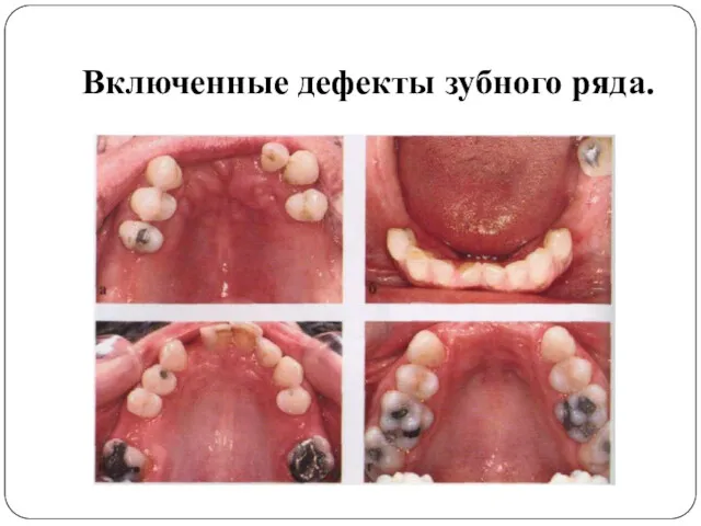 Включенные дефекты зубного ряда.