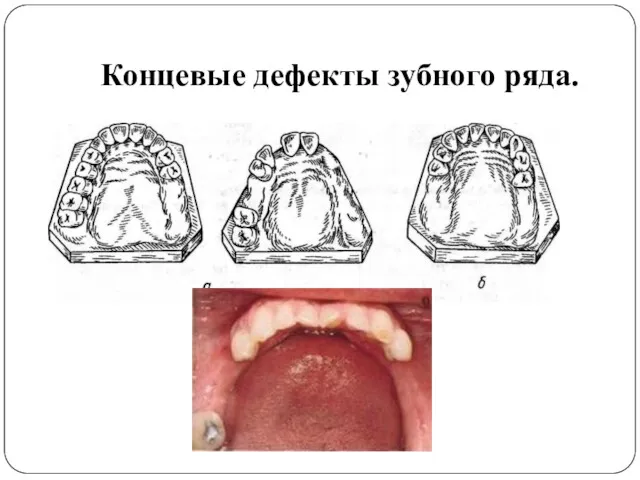 Концевые дефекты зубного ряда.