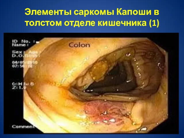 Элементы саркомы Капоши в толстом отделе кишечника (1)