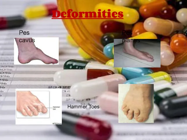 Deformities Pes cavus Pes planus Hammer Toes