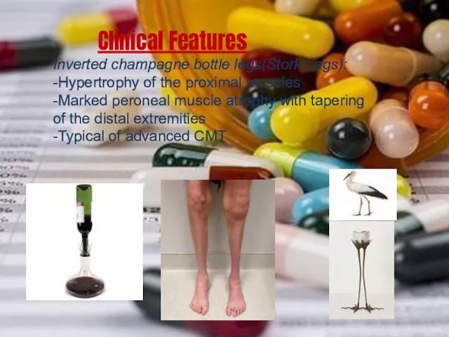 Clinical Features Inverted champagne bottle legs(Stork Legs): -Hypertrophy of the