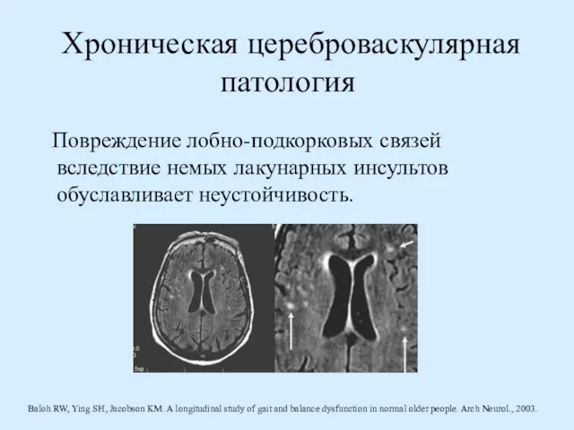 Хроническая цереброваскулярная патология Повреждение лобно-подкорковых связей вследствие немых лакунарных инсультов