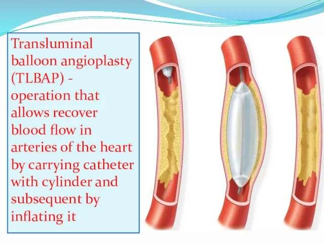 Transluminal balloon angioplasty (TLBAP) - operation that allows recover blood flow in arteries