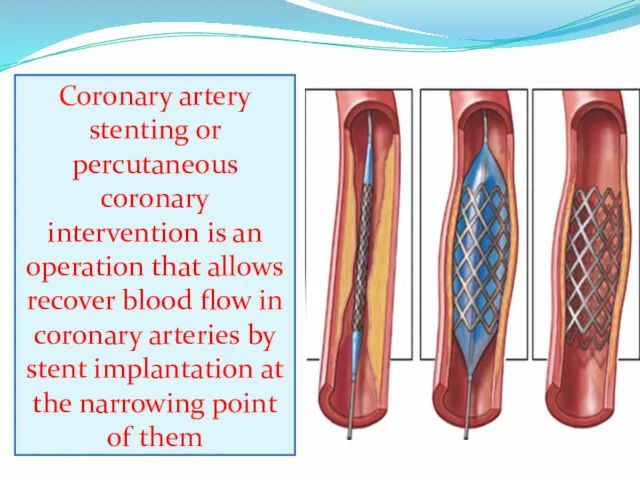Coronary artery stenting or percutaneous coronary intervention is an operation that allows recover