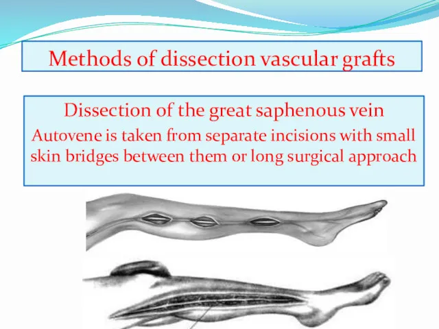 Methods of dissection vascular grafts Dissection of the great saphenous vein Autovene is