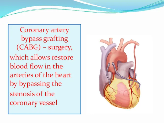 Coronary artery bypass grafting (CABG) – surgery, which allows restore blood flow in