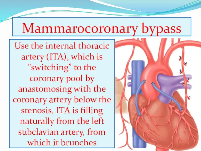 Mammarocoronary bypass Use the internal thoracic artery (ITA), which is "switching” to the