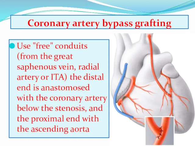 Coronary artery bypass grafting Use "free" conduits (from the great saphenous vein, radial