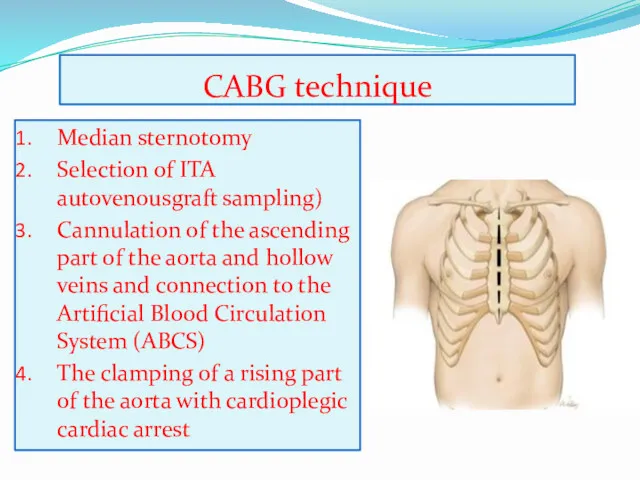 CABG technique Median sternotomy Selection of ITA autovenousgraft sampling) Cannulation of the ascending