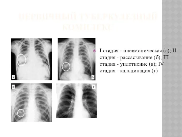 ПЕРВИЧНЫЙ ТУБЕРКУЛЕЗНЫЙ КОМПЛЕКС I стадия - пневмоническая (а); II стадия