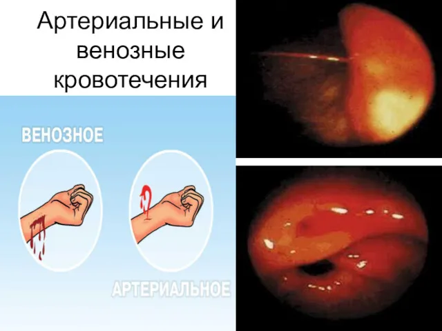 Артериальные и венозные кровотечения