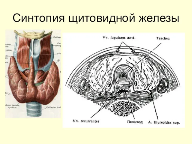 Синтопия щитовидной железы