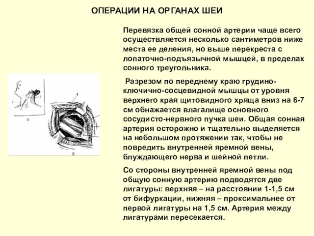 ОПЕРАЦИИ НА ОРГАНАХ ШЕИ Перевязка общей сонной артерии чаще всего осуществляется несколько сантиметров