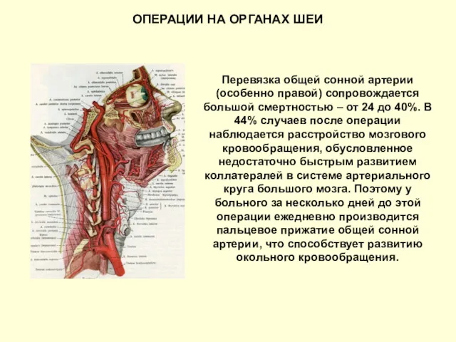 ОПЕРАЦИИ НА ОРГАНАХ ШЕИ Перевязка общей сонной артерии (особенно правой)