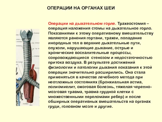 ОПЕРАЦИИ НА ОРГАНАХ ШЕИ Операции на дыхательном горле. Трахеостомия – операция наложения стомы