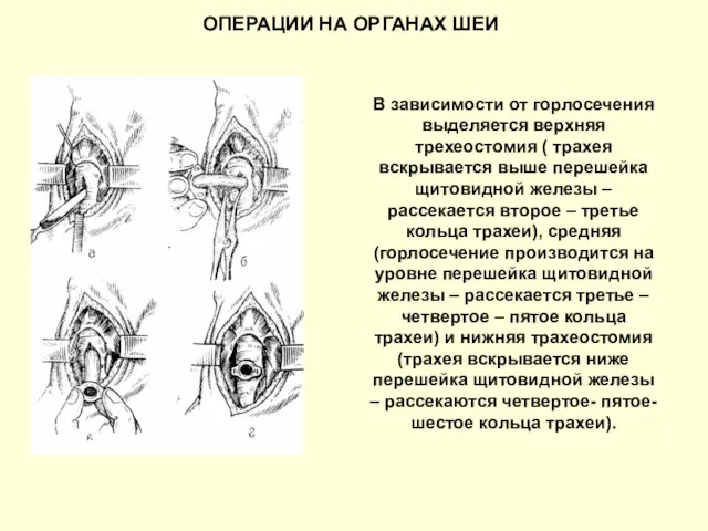 В зависимости от горлосечения выделяется верхняя трехеостомия ( трахея вскрывается