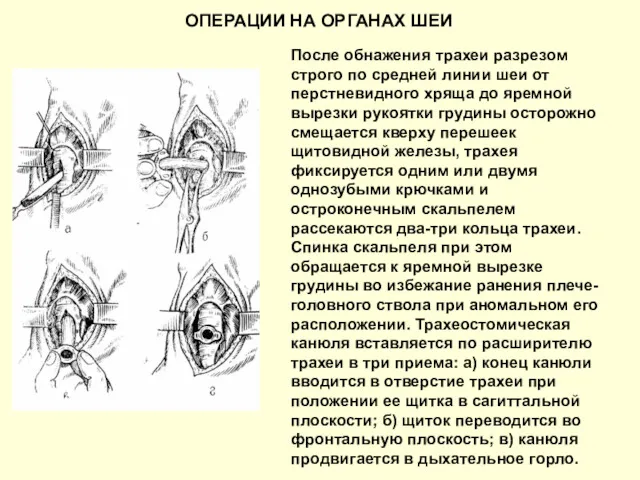 ОПЕРАЦИИ НА ОРГАНАХ ШЕИ После обнажения трахеи разрезом строго по средней линии шеи