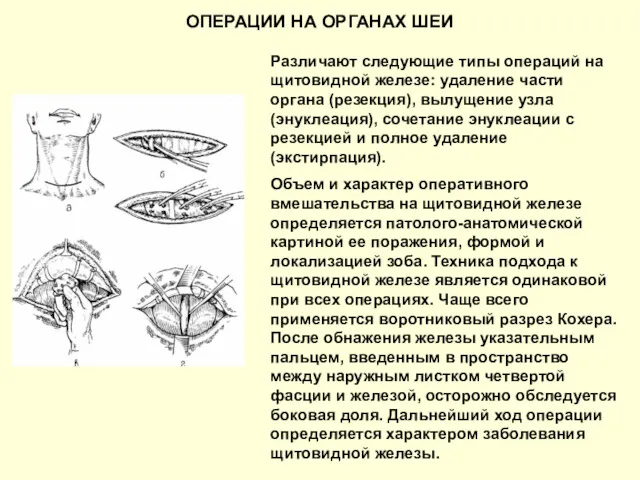 ОПЕРАЦИИ НА ОРГАНАХ ШЕИ Различают следующие типы операций на щитовидной