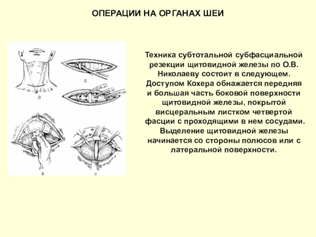 ОПЕРАЦИИ НА ОРГАНАХ ШЕИ Техника субтотальной субфасциальной резекции щитовидной железы по О.В.Николаеву состоит