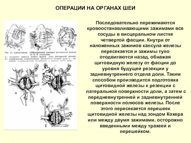 Последовательно пережимаются кровоостанавливающими зажимами все сосуды в висцеральном листке четвертой