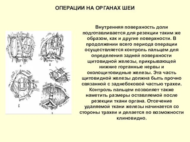 ОПЕРАЦИИ НА ОРГАНАХ ШЕИ Внутренняя поверхность доли подготавливается для резекции