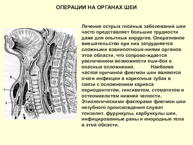 ОПЕРАЦИИ НА ОРГАНАХ ШЕИ Лечение острых гнойных заболеваний шеи часто представляет большие трудности