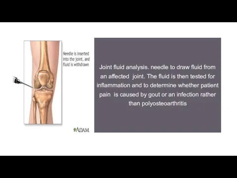 Joint fluid analysis. needle to draw fluid from an affected