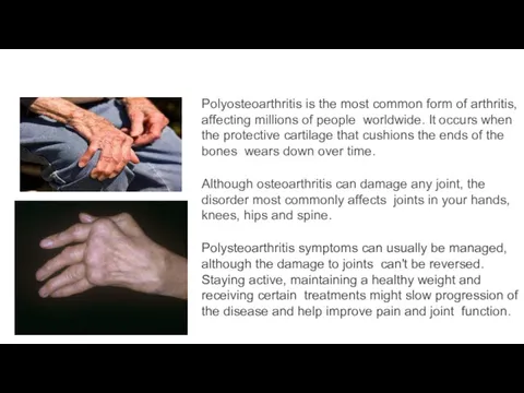 Polyosteoarthritis is the most common form of arthritis, affecting millions