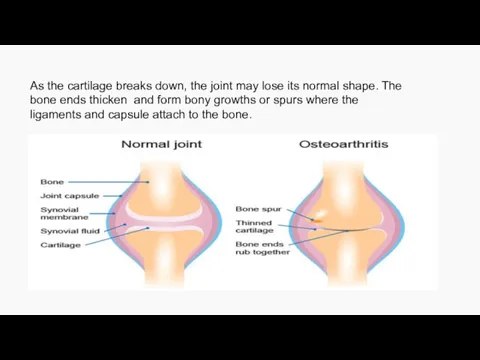 As the cartilage breaks down, the joint may lose its
