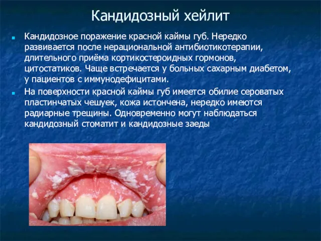 Кандидозный хейлит Кандидозное поражение красной каймы губ. Нередко развивается после нерациональной антибиотикотерапии, длительного