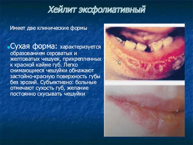 Хейлит эксфолиативный Имеет две клинические формы Сухая форма: характеризуется образованием