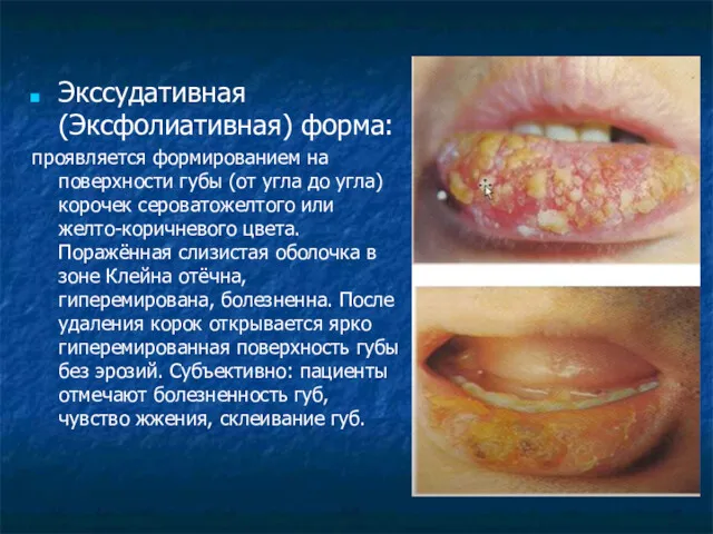 Экссудативная (Эксфолиативная) форма: проявляется формированием на поверхности губы (от угла до угла) корочек