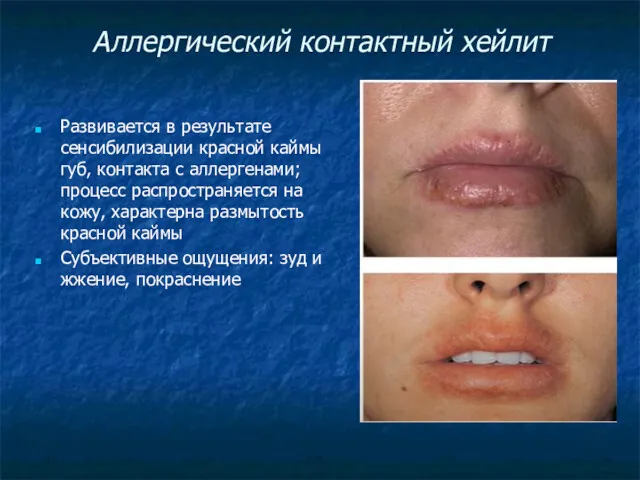 Аллергический контактный хейлит Развивается в результате сенсибилизации красной каймы губ, контакта с аллергенами;