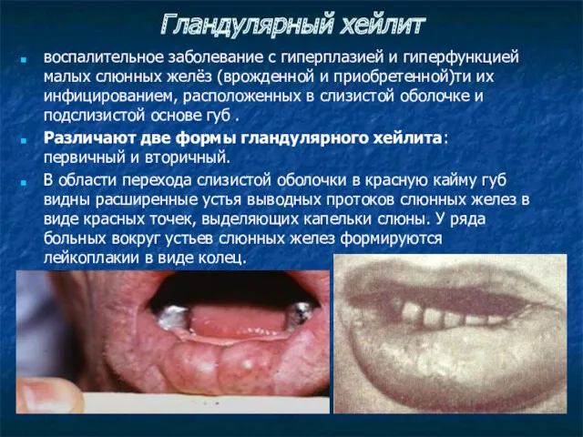 Гландулярный хейлит воспалительное заболевание с гиперплазией и гиперфункцией малых слюнных желёз (врожденной и