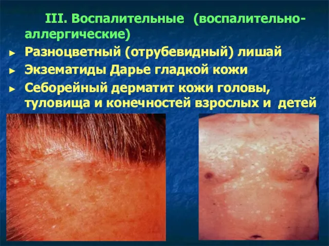 III. Воспалительные (воспалительно-аллергические) Разноцветный (отрубевидный) лишай Экзематиды Дарье гладкой кожи