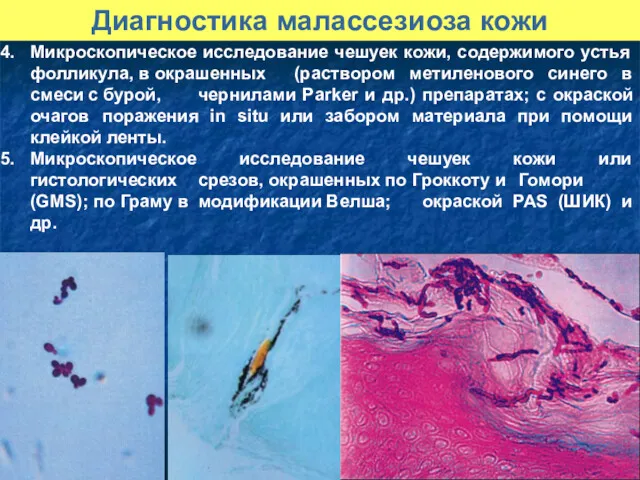 Микроскопическое исследование чешуек кожи, содержимого устья фолликула, в окрашенных (раствором