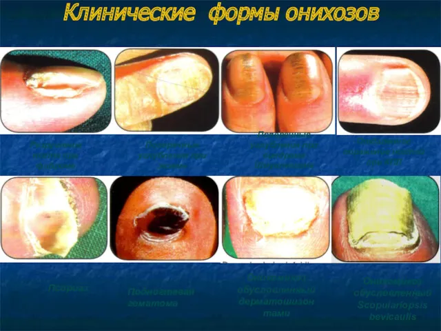Клинические формы онихозов Разрушение ногтя при фиброме Псориаз Поперечные углубления