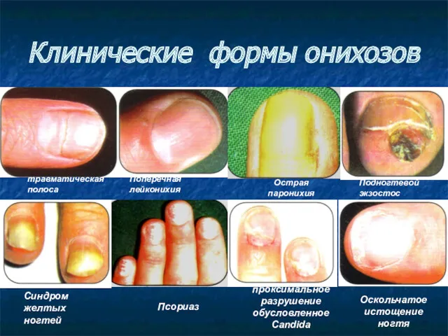 травматическая полоса Псориаз Поперечная лейконихия Острая паронихия Синдром желтых ногтей