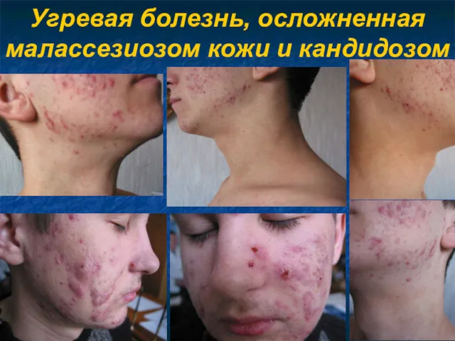 Угревая болезнь, осложненная малассезиозом кожи и кандидозом